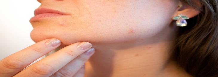 As Per Research,Ticks Impair Skin's Immune System